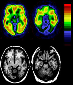 PET images are on top. MRI images showing matching anatomy are on bottom. Areas of red and yellow show increased uptake of the altanserin tracer due to binding to the serotonin receptors.