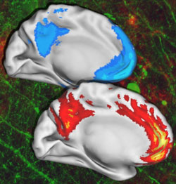 Brain regions active during default mental  tates in young adults reveal remarkable correlation with those regions showing Alzheimer's disease pathology.