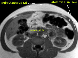 In this abdominal MRI scan, it is possible to see subcutaneous fat around the abdomen, surrounding