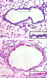 Top: cross section of an airway in the lung of a normal mouse. Bottom: cross section of an airway of a mouse with high TSLP: visible are large goblet cells (dark pink), the hallmark of asthma.