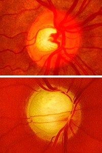 WASHINGTON UNIVERSITY SCHOOL OF MEDICINE/The changing appearance of the optic nerve at the rear of the eye displays an increase in glaucoma risk, as a healthy optic nerve head (top photo) begins to show signs of damage (bottom).