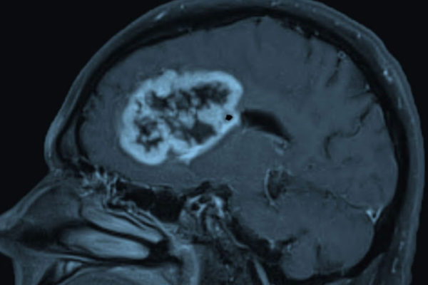 Potential drug target identified for deadly brain cancer
