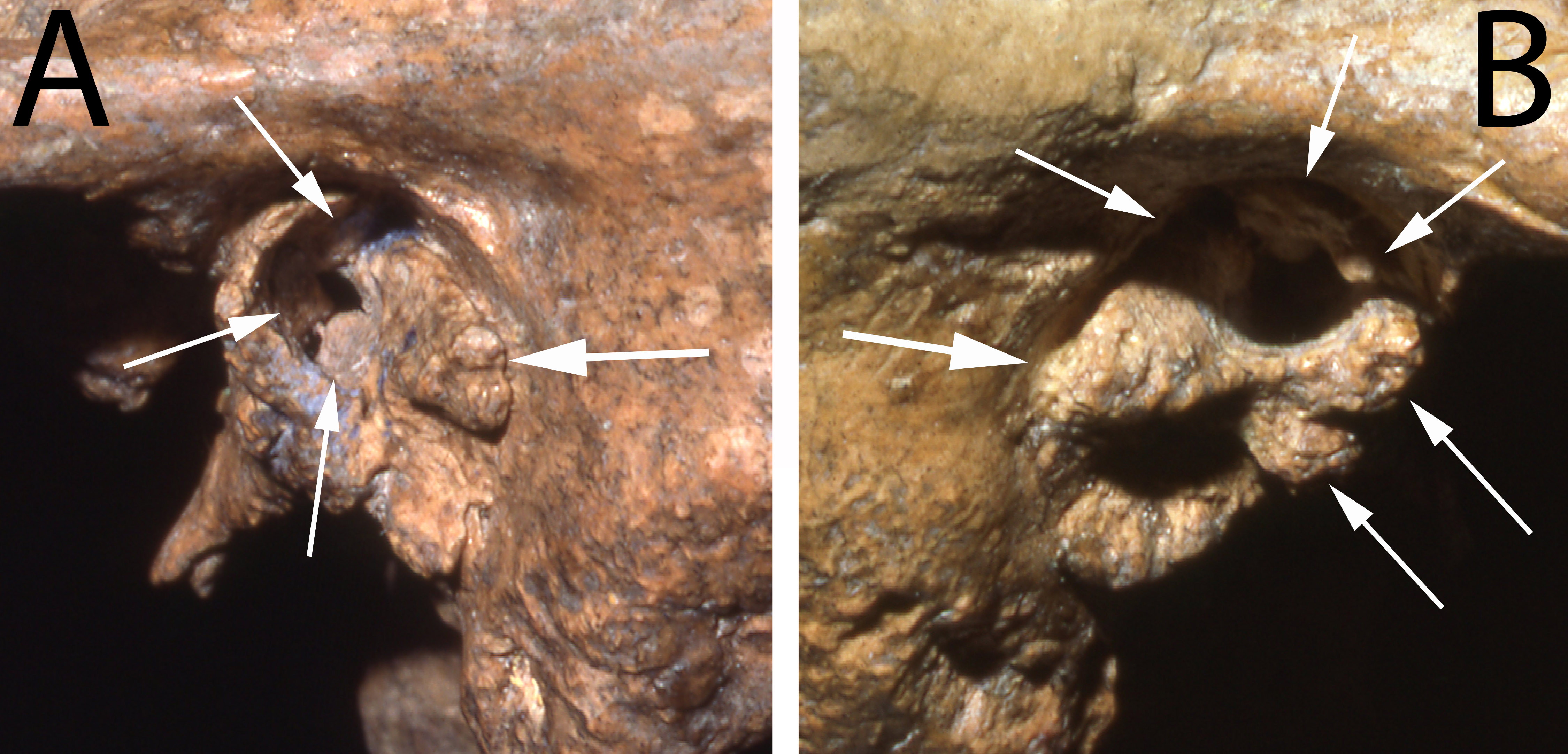 Two views of the ear canal of the Neandertal fossil Shanidar 1 show substantial deformities that would likely have caused profound deafness.