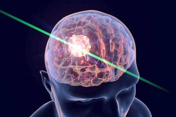 Lasers help fight deadly brain tumors