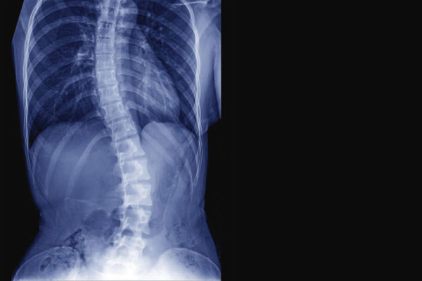 Scoliosis linked to essential mineral