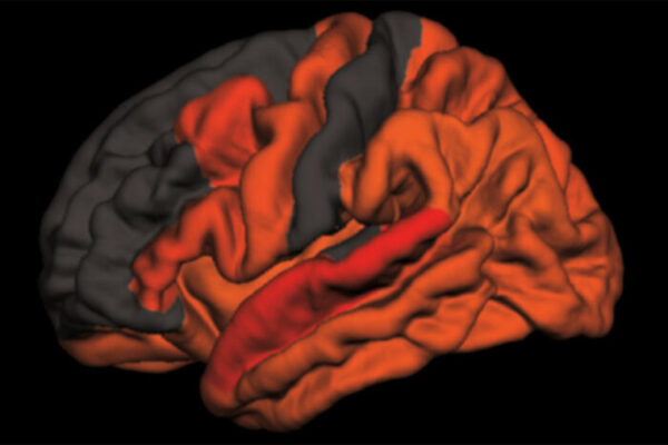 Decreased deep sleep linked to early signs of Alzheimer’s disease