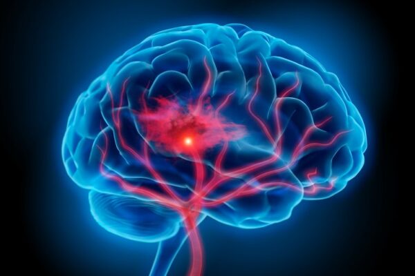 ‘Unprecedented opportunity’ to understand neurovascular recovery after stroke