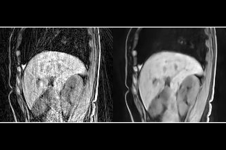 Side-by-side comparisons of reconstructed MRI images