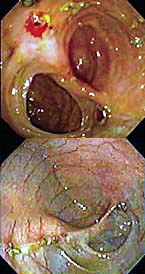 Patients treated in the GM-CSF pilot study showed a decrease in inflammation: an inflamed colon before treatment (top) and after, showing no pathologic abnormality.