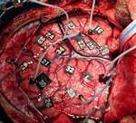 Improved imaging of brain's language areas may replace more invasive pre-surgery mapping techniques, such as  the electrocortical stimulation method shown here.