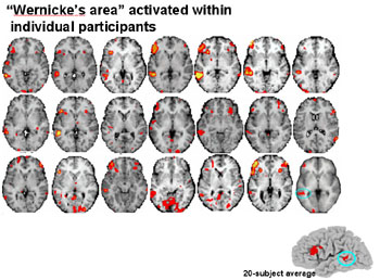 The Broca and Wernicke language areas are typically concentrated in two particular regions of the brain in most people, but their exact locations in individuals can be tremendously variable, as shown by the images above.