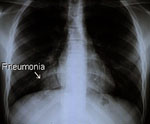 Chest x-ray of a lung affected by pneumonia