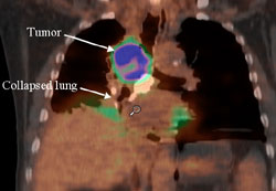 When treating lung cancer with radiation, precisely locating and targeting the tumor may help avoid inflammation of the esophagus.