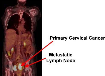 PET scans can help identify tumors in the cervix and the possible spread of cancer through the lymph nodes.