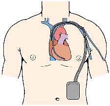 Implantable defibrillators are downscaled to fit inside a person's chest to monitor heart activity.