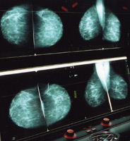Mammograms could more frequently bear good news if researchers develop an effective breast cancer vaccine.