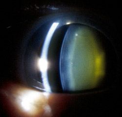 This eye of a 72-year-old woman shows normal yellowing of the lens due to age-related nuclear sclerotic cataract.
