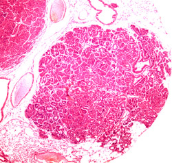 Lung tumors from mutant mice show an abundance of abnormal, undifferentiated cells.