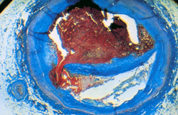 This image shows a blood vessel that has become narrowed due to the build-up of cholesterol and other vessel-clogging substances.
