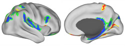 Abnormal folding patterns of the cerebral cortex in Williams Syndrome