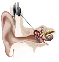 A cochlear implant's external component senses sound and sends electrical signals to an internal component that stimulates the hearing nerves in the inner ear.