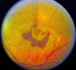 Abnormal blood vessels  and hemorrhage underneath the retina in the wet form of age-related macular degeneration