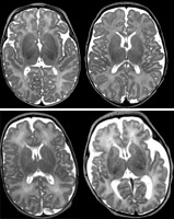 In a pre-term infant's brain, an MRI scan can reveal abnormalities that were undetected by previous methods. The scans on the left show normal gray matter, while those on the right show abnormal gray matter.