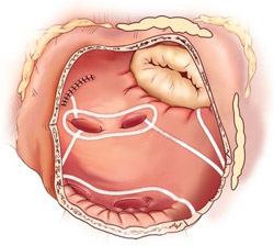 This illustration of the Cox-Maze procedure shows the ablation lines in the left atrium.