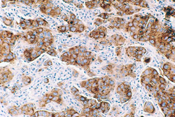 In this image, breast cancer cells are stained brown using an antibody that recognizes an antigen found within malignant cells.