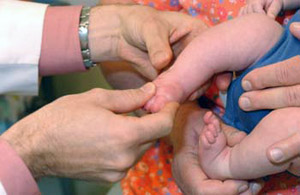 Clubfoot, one of the most common birth defects, affects 1 in 1,000 children.
