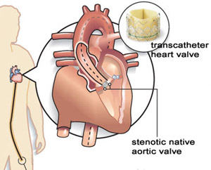 Heart Valve Replacement Without Open Heart Surgery Is Subject Of