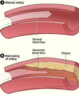 Atherosclerosis in an artery (B)
