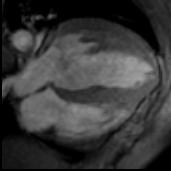 This MRI shows ventricular hypertrophy.