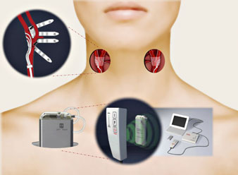 Similar to a pacemaker, the iPod-sized device is implanted under the skin near the collarbone, with wires that carry electrical signals to nerve receptors along the carotid arteries in the neck. The signals activate the body's own system for lowering bloo