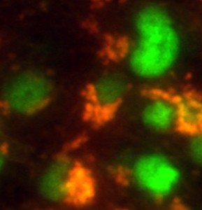 Brain tumor stem cells (orange) in mice express a stem cell marker (green). Researchers at Washington University School of Medicine in St. Louis are studying how cancer stem cells make tumors harder to kill and are looking for ways to eradicate these treatment-resistant cells.