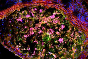 A new study suggests that plaque forming in arteries has much in common with the progression of Alzheimer’s disease. The image shows a cross section of a mouse aorta, the main artery in the body, with a large plaque. Red lines near the top are the wall of the aorta. The plaque contains a dysfunctional buildup of immune cells called macrophages (pink) and protein waste (green). (Credit: I. Sergin)