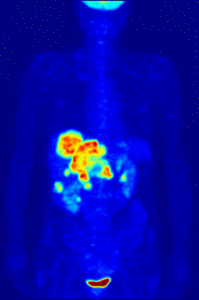 Whole-body PET scan using 18F-FDG to show liver metastases of a colorectal tumor