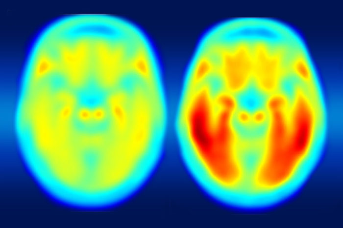 Scientists at Washington University are collaborating with the pharmaceutical companies AbbVie, Biogen and Eli Lilly & Co. to investigate the buildup and clearance of tau protein in the brains of patients with Alzheimer’s disease. The PET image on the left shows the average tau accumulation in the brains of cognitively normal people, averaged over many individuals. The image on the right shows the average amount of tau buildup in the brains of multiple people with mild Alzheimer's symptoms. (Image: Matthew R. Brier)