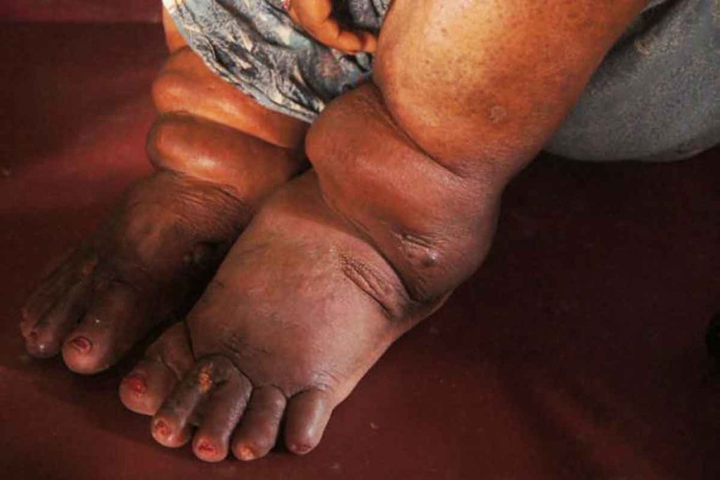 A woman in India suffers severe swelling in her legs due to elephantiasis, a tropical disease. Researchers at Washington University School of Medicine in St. Louis have received an $8 million grant to work toward eliminating the parasitic condition. (Photo: Caitlin Worrell/Centers for Disease Control and Prevention)