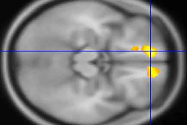 Researchers at Washington University School of Medicine in St. Louis have identified areas in the brains of children with Tourette’s syndrome that appear markedly different from the same areas in brains of children who don’t have the disorder. Above, in a scan of a child with Tourette’s, yellow indicates an area with less white matter than in the same brain region in kids who don't have the disorder. The scans also revealed areas in the brains of kids with Tourette's that have more gray matter than in children without the condition. (Image: Kevin J. Black)