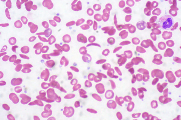 $4 million funds study of sickle cell disease in teens, adults