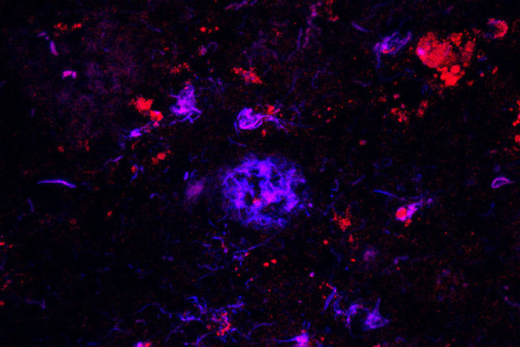 Antibodies against APOE (red) bind to amyloid plaques (blue) in brain tissue