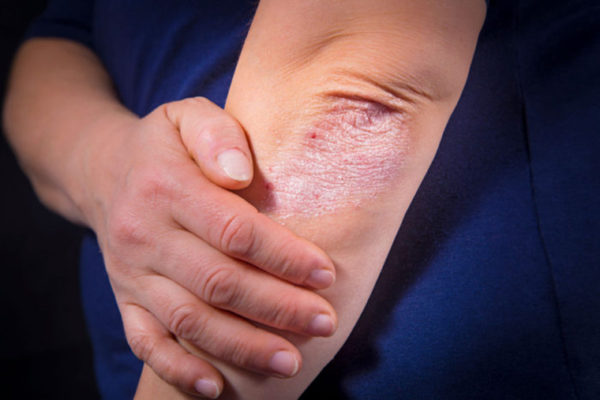 Psoriasis treated with compound derived from immune cells
