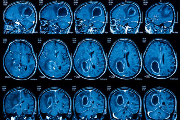 Brain cancer vaccine effective in some patients