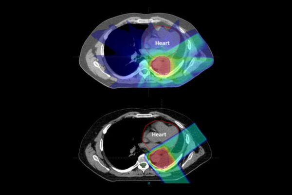 Proton therapy for cancer lowers risk of side effects