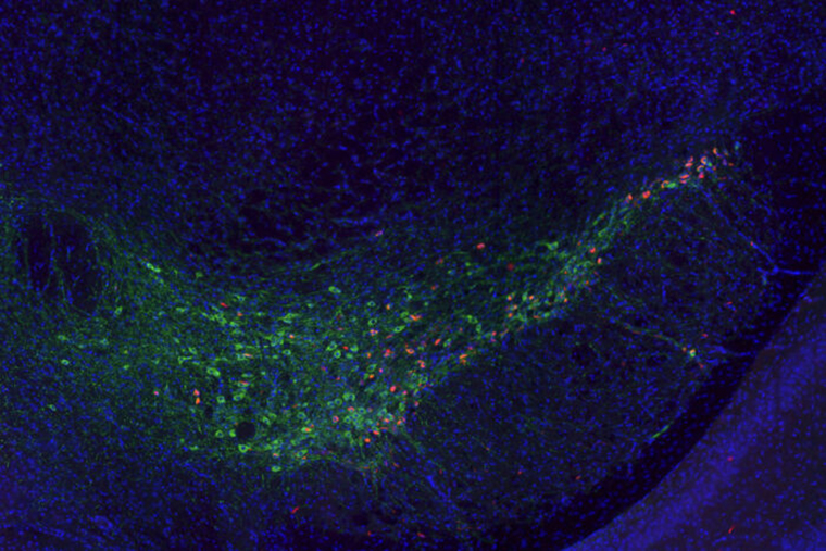 The Parkinson's proteins are sporadic and red against many green specks (neurons)
