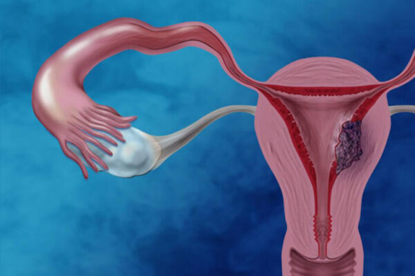 Fight against endometrial cancer boosted with new molecular road map
