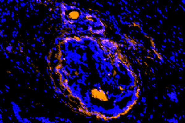 Cancerous tumors, surrounding cells illuminated by new imaging agent