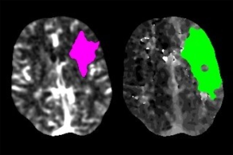 Scans of a stroke patient's brain show