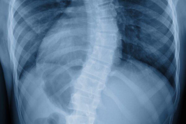 Severe scoliosis in African Americans focus of $3.2 million grant
